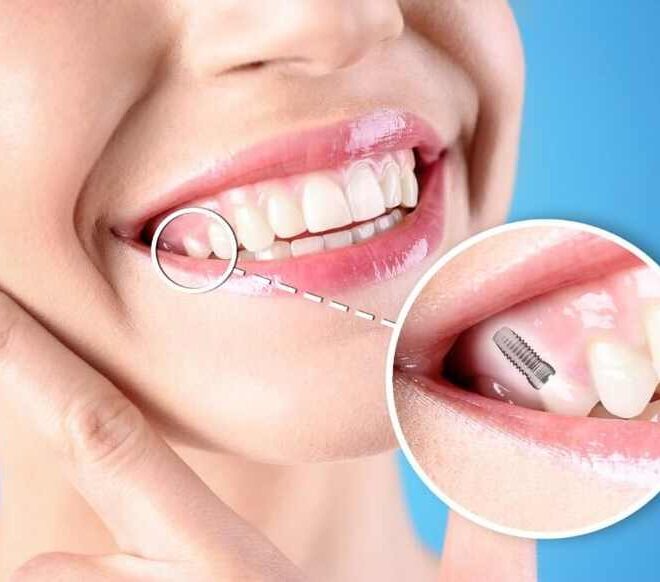 Cutting-Edge Solutions for Tooth Replacement Needs